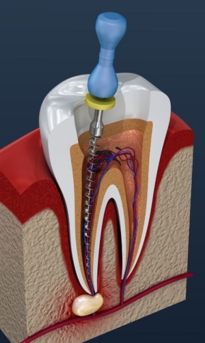 Root Canal Treatment